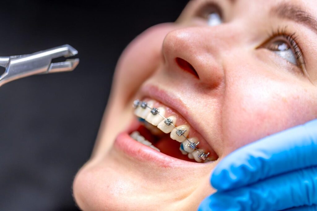 braces removal