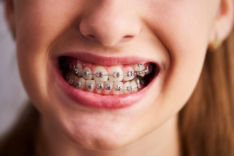 Self Ligating Brackets