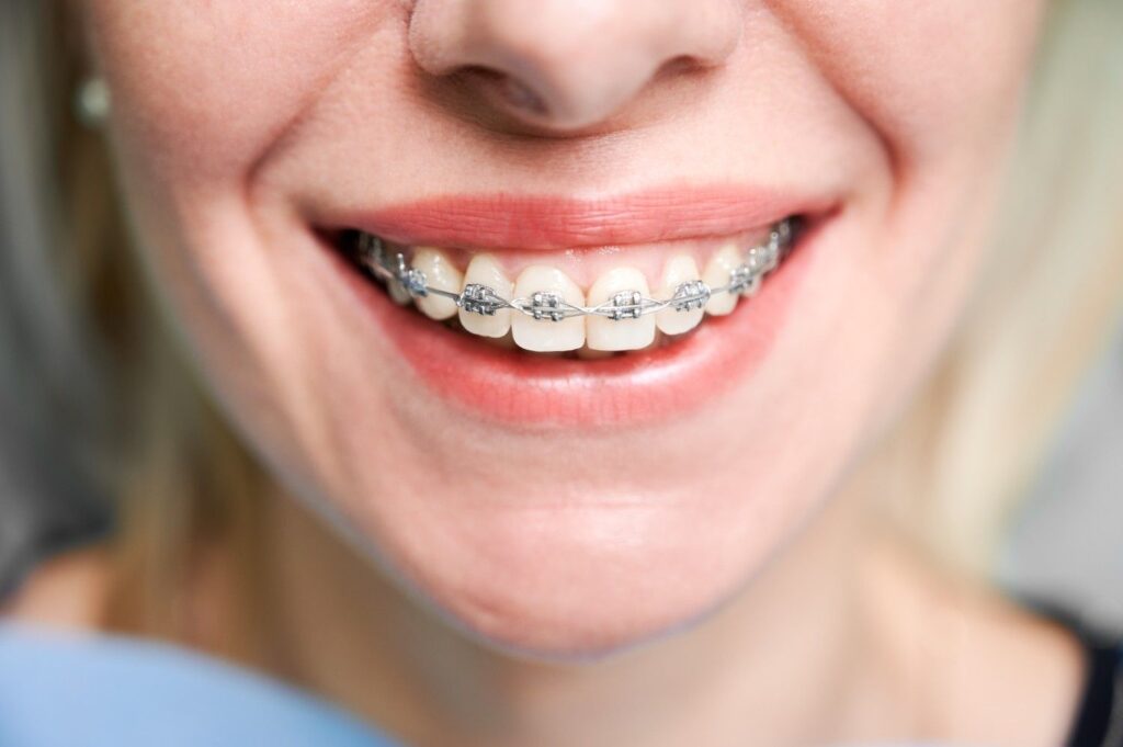 self ligating braces
