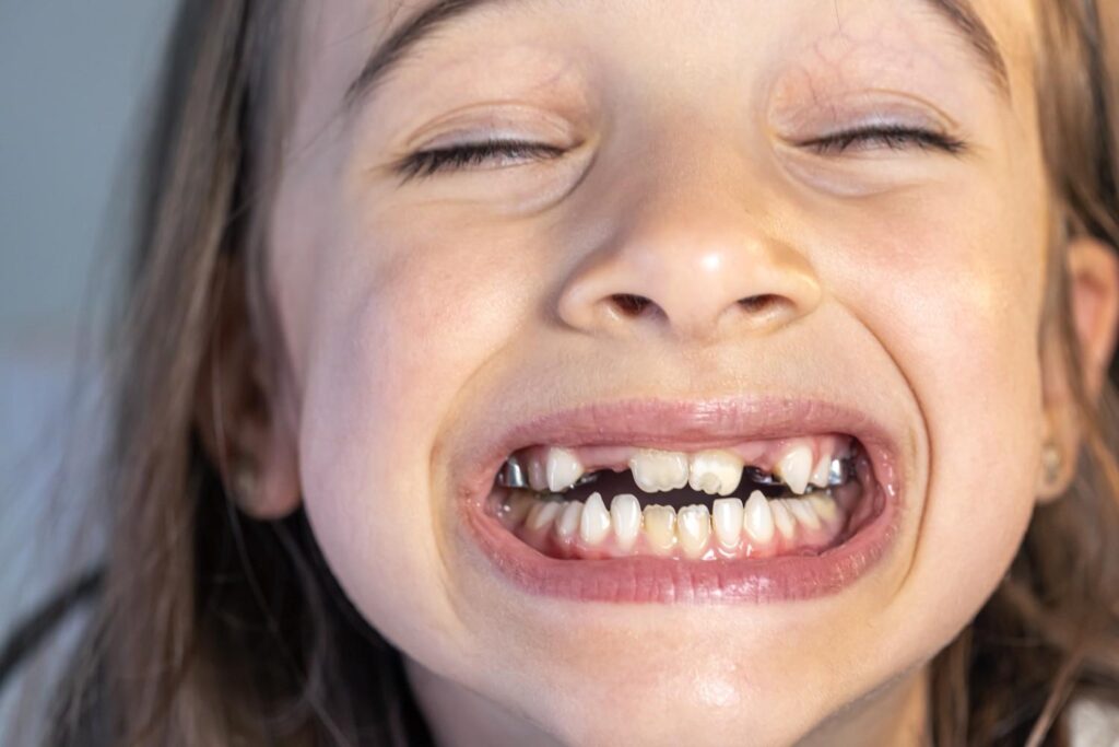 Crooked-Teeth