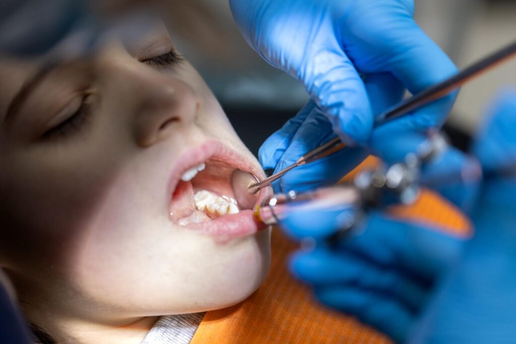 Interproximal Cavities