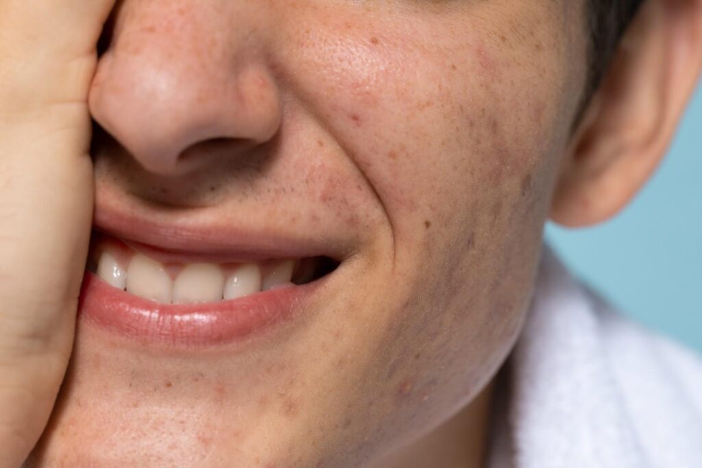 Brown-Spot-on-Tooth