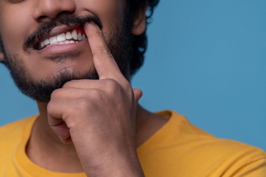 White-Spots-on-Gums