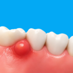 Gum boil on the gums near a tooth
