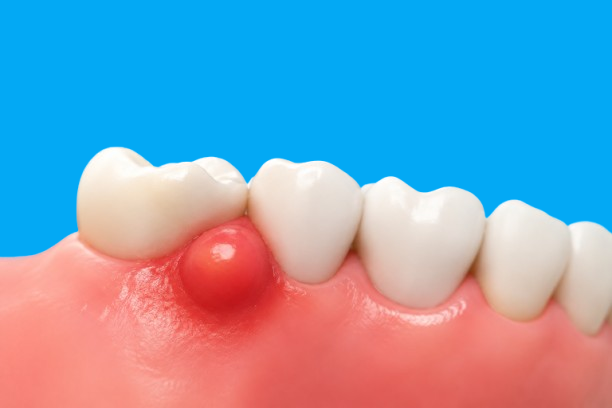 Gum boil on the gums near a tooth